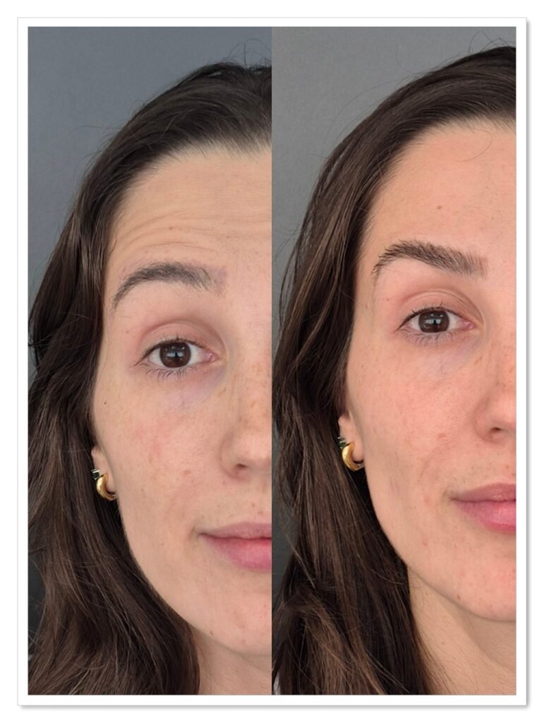 Botox Morumbi Simone Paradela