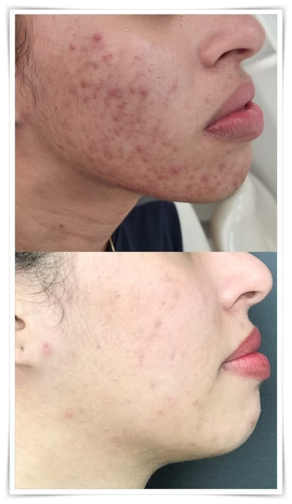 Peeling avançado