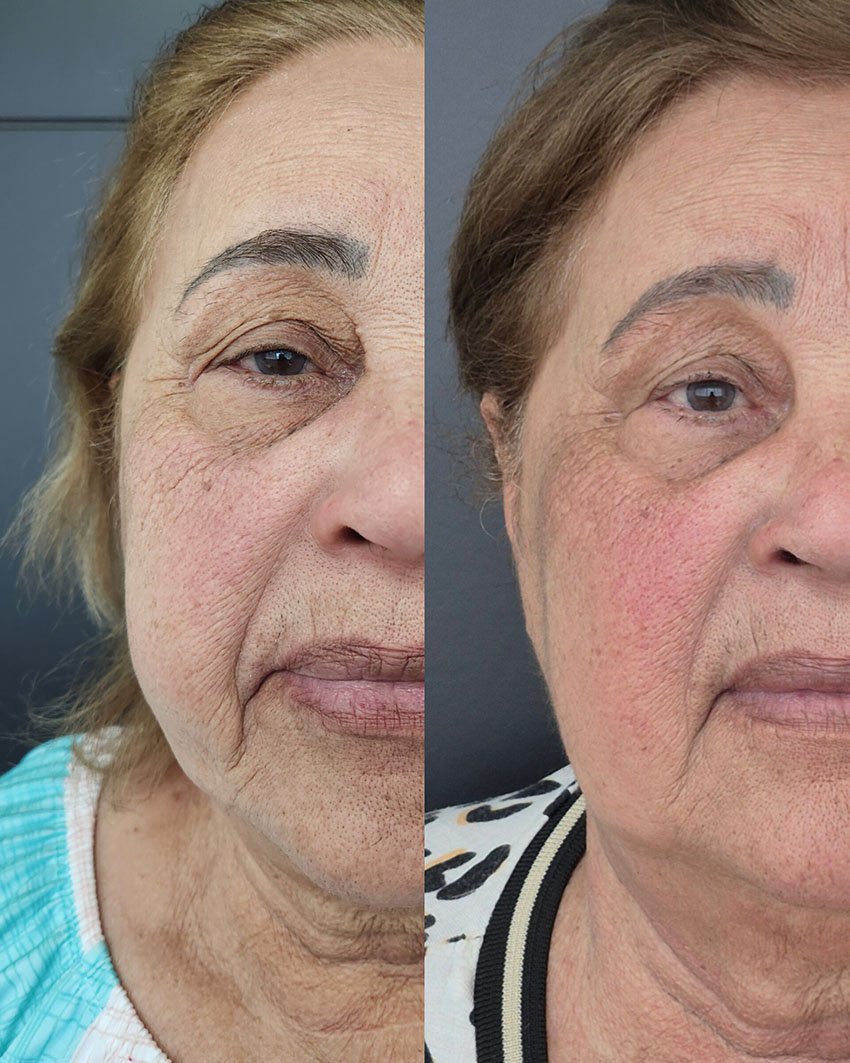 Antes e Depois Estetica no Morumbi4