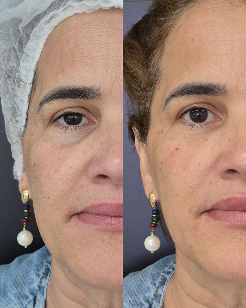 Antes e Depois Estetica no Morumbi5