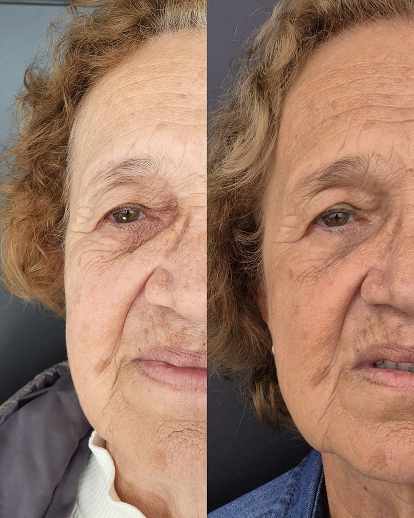 Antes e Depois - Estética no Morumbi3